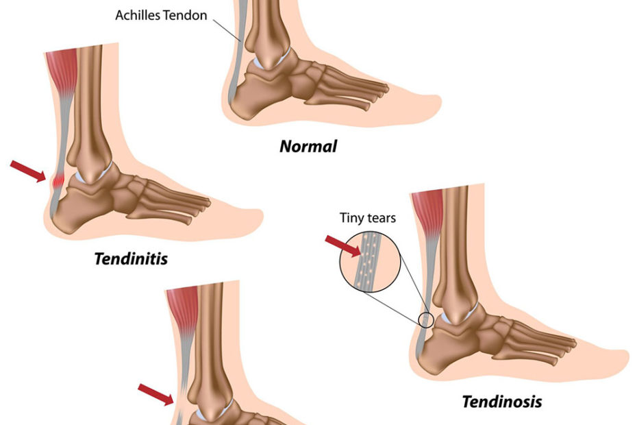 Achilles Tendonitis-osis (Alila Medical Images, Alamy Stock Photo)