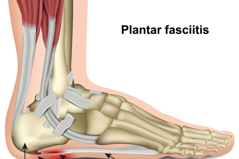 Plantar Fasciitis Side 2 (Medicalstocks, Getty Images)