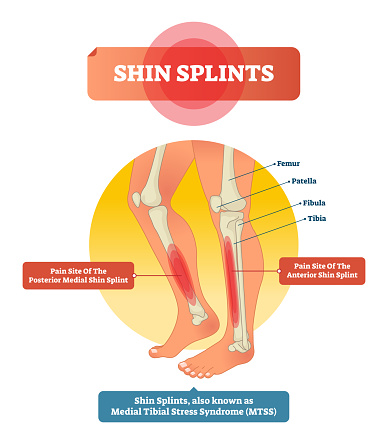 Shin Splints (iStock)